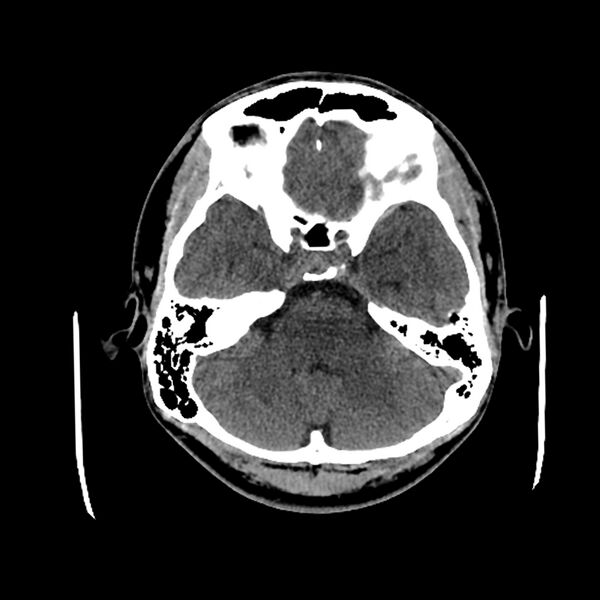 File:Central neurocytoma (Radiopaedia 79320-92379 Axial non-contrast 13).jpg