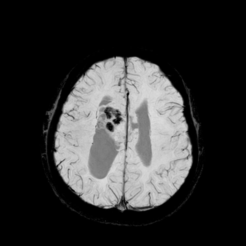 Central neurocytoma (Radiopaedia 79320-92380 Axial SWI 100).jpg