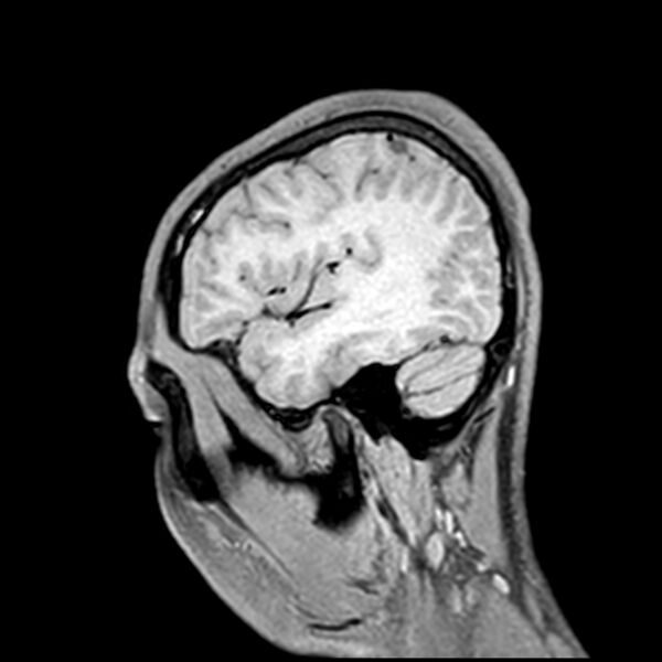 File:Central neurocytoma (Radiopaedia 79320-92380 Sagittal T1 207).jpg
