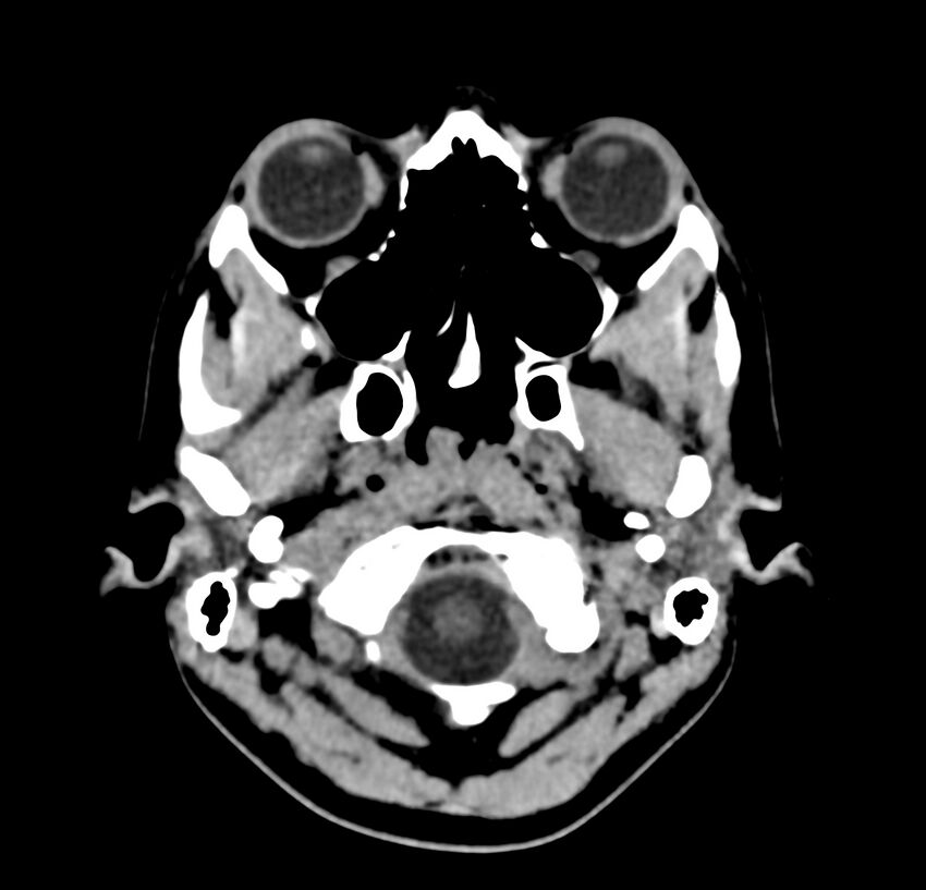 Cerebellar agenesis (Radiopaedia 30203-30817 Axial non-contrast 1).jpg