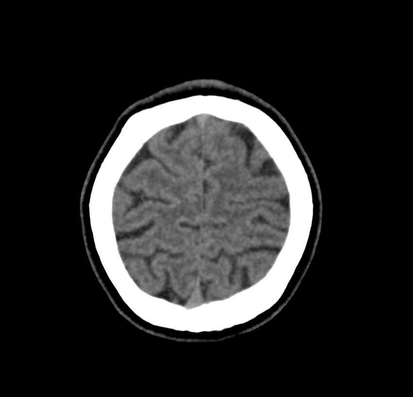 Cerebellar agenesis (Radiopaedia 30203-30817 Axial non-contrast 44).jpg