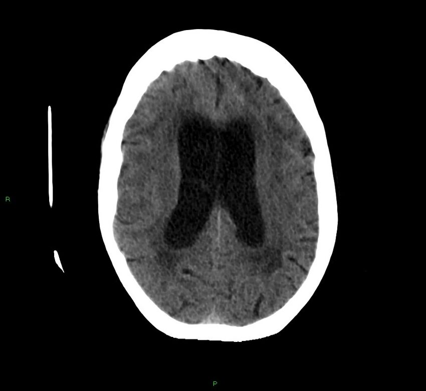Cerebellar hemorrhage (Radiopaedia 58792-66026 Axial non-contrast 20).jpg