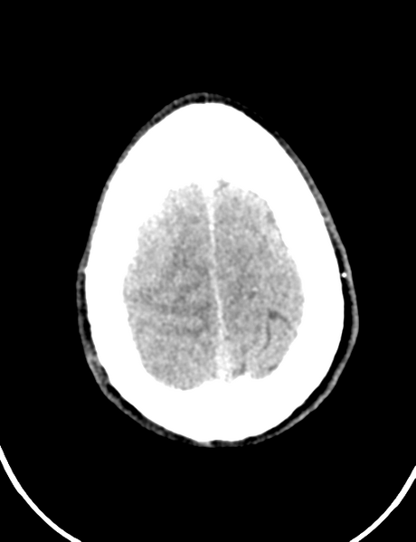 File:Cerebral abscess (Radiopaedia 60342-68008 Axial non-contrast 46).png