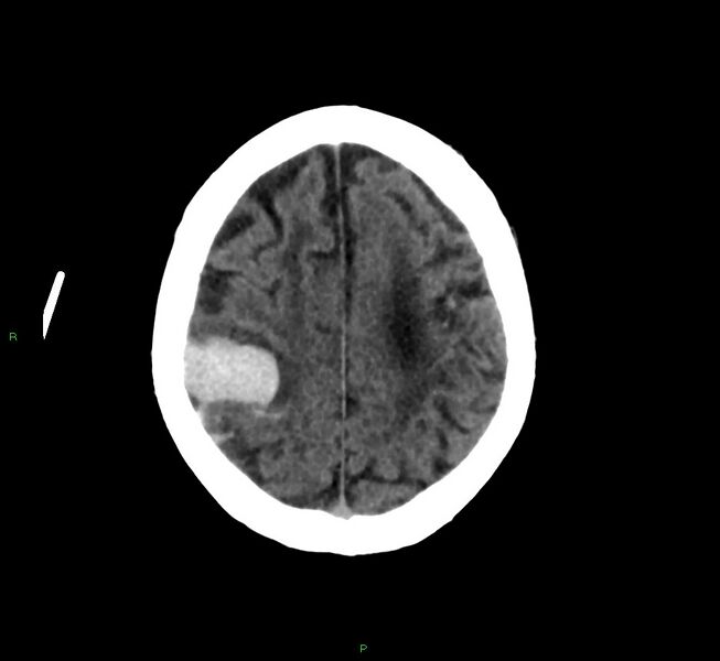File:Cerebral amyloid angiopathy-associated lobar intracerebral hemorrhage (Radiopaedia 58376-65513 Axial non-contrast 14).jpg