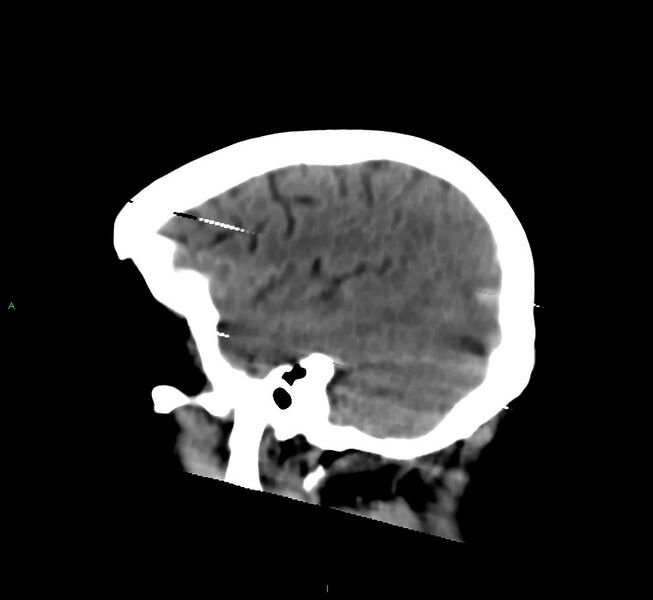 File:Cerebral amyloid angiopathy-associated lobar intracerebral hemorrhage (Radiopaedia 58377-65514 B 11).jpg