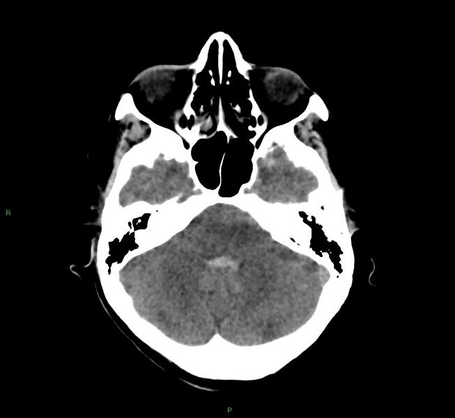 File:Cerebral amyloid angiopathy-associated lobar intracerebral hemorrhage (Radiopaedia 58566-65730 Axial non-contrast 39).jpg