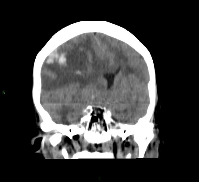 File:Cerebral amyloid angiopathy-associated lobar intracerebral hemorrhage (Radiopaedia 58751-65972 Coronal non-contrast 36).jpg