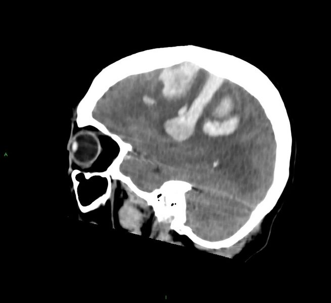 File:Cerebral amyloid angiopathy-associated lobar intracerebral hemorrhage (Radiopaedia 58756-65977 C 19).jpg