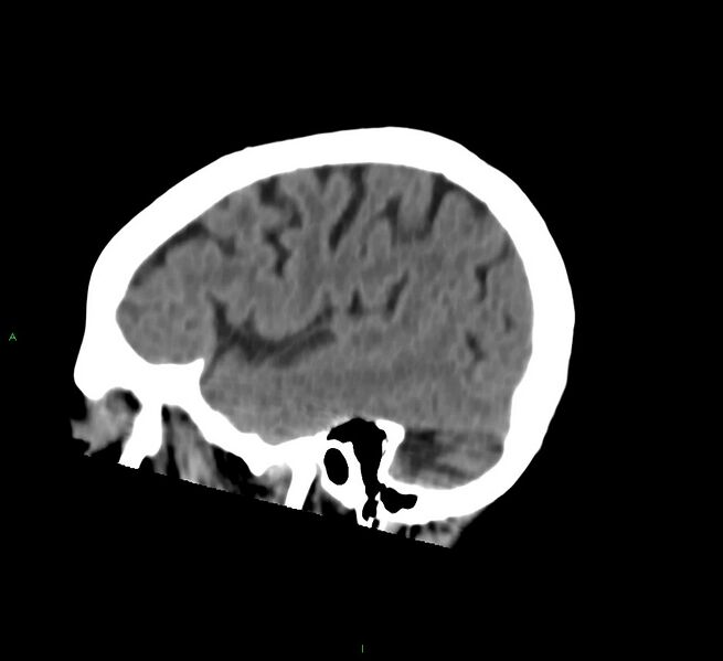 File:Cerebral amyloid angiopathy-associated lobar intracerebral hemorrhage (Radiopaedia 58757-65978 C 13).jpg