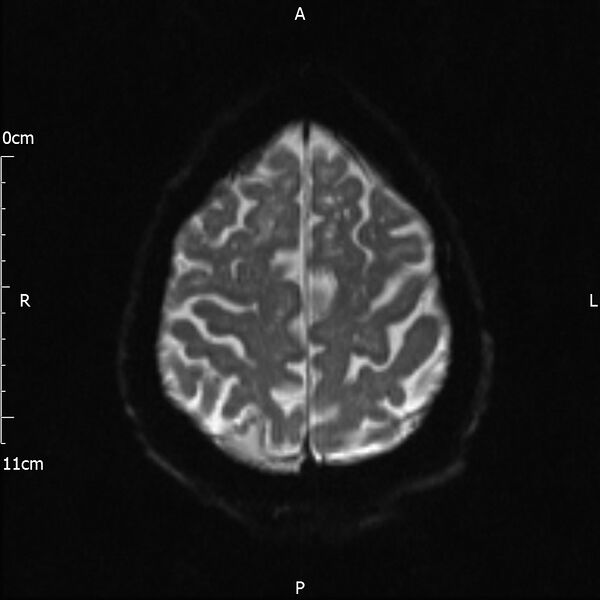 File:Cerebral amyloid angiopathy related inflammation (Radiopaedia 72772-83415 Axial DWI 19).jpg