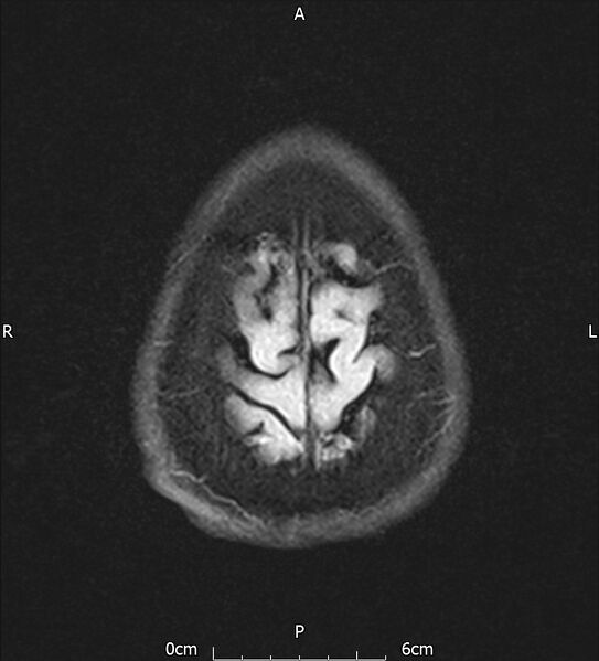 File:Cerebral amyloid angiopathy related inflammation (Radiopaedia 72772-83415 Axial FLAIR 22).jpg