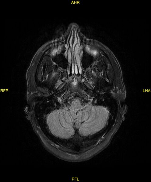 File:Cerebral autosomal dominant arteriopathy with subcortical infarcts and leukoencephalopathy (CADASIL) (Radiopaedia 86108-102054 Axial FLAIR 6).jpg