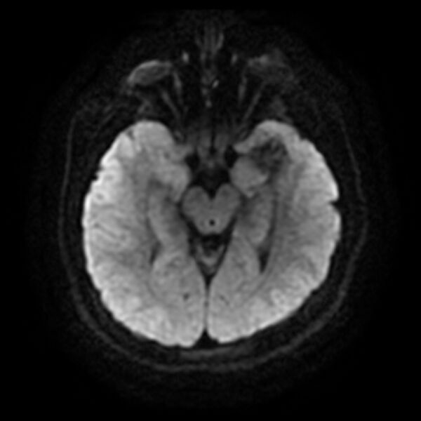 File:Cerebral cavernous malformation (Radiopaedia 44301-47942 Axial DWI 9).jpg