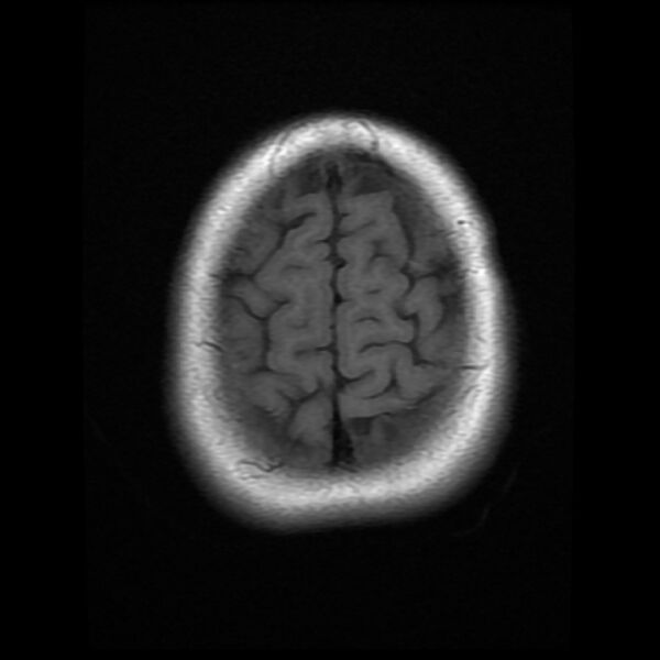 File:Cerebral cavernous malformation (Radiopaedia 44301-47942 Axial T1 19).jpg
