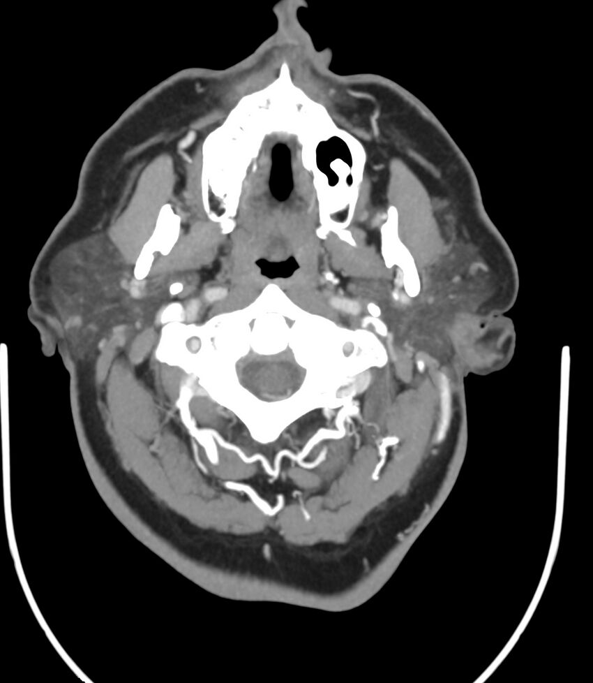 Cerebral dural venous sinus thrombosis (Radiopaedia 86514-102576 A 18).jpg