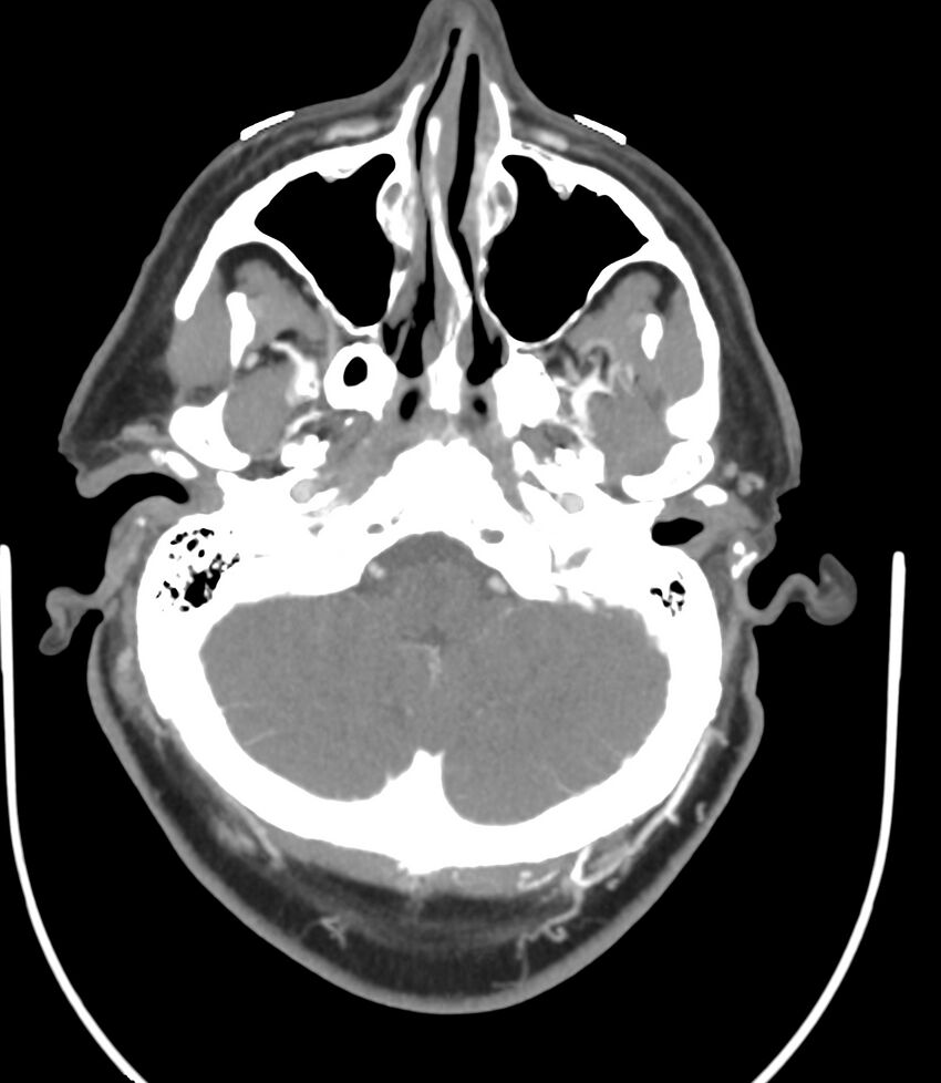 Cerebral dural venous sinus thrombosis (Radiopaedia 86514-102576 A 30).jpg