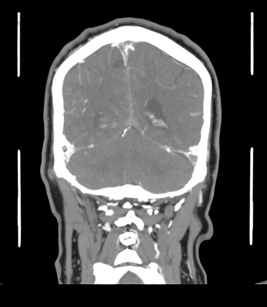 File:Cerebral dural venous sinus thrombosis (Radiopaedia 86514-102576 B 56).jpg