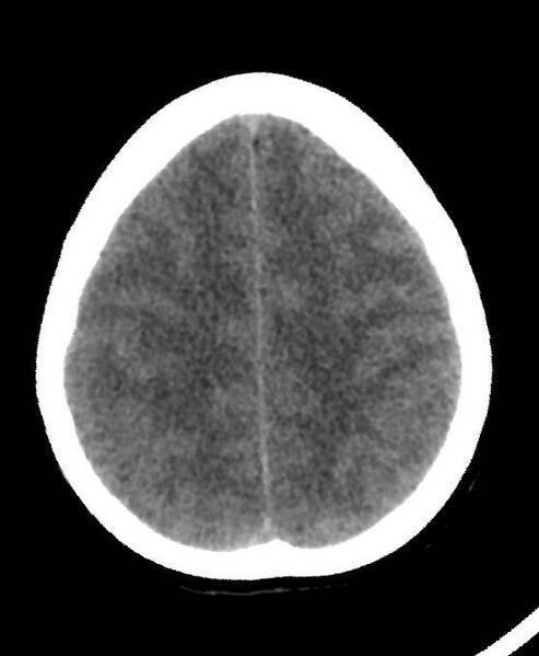 File:Cerebral edema due to severe hyponatremia (Radiopaedia 89826-106937 Axial non-contrast 72).jpg