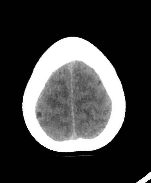 File:Cerebral edema due to severe hyponatremia (Radiopaedia 89826-106937 Axial non-contrast 82).jpg