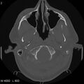 Cerebral hemorrhagic contusion with subdural and subarachnoid hemorrhage (Radiopaedia 10680-11146 Axial bone window 2).jpg