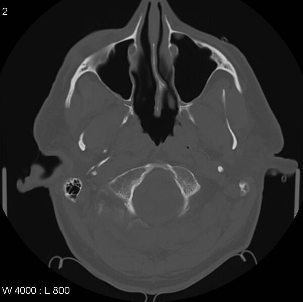 File:Cerebral hemorrhagic contusion with subdural and subarachnoid hemorrhage (Radiopaedia 10680-11146 Axial bone window 2).jpg