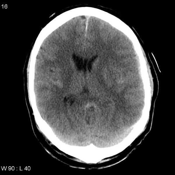File:Cerebral hemorrhagic contusion with subdural and subarachnoid hemorrhage (Radiopaedia 10680-19197 Axial non-contrast 12).jpg