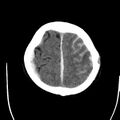 Cerebral hemorrhagic contusions (Radiopaedia 23145-23188 Axial non-contrast 34).jpg