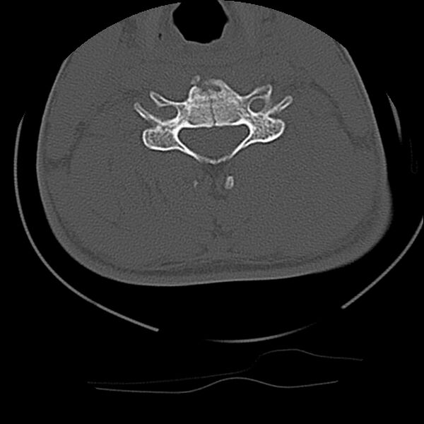 File:Cervical flexion teardrop fracture with cord hemorrhage (Radiopaedia 32497-33454 Axial bone window 50).jpg