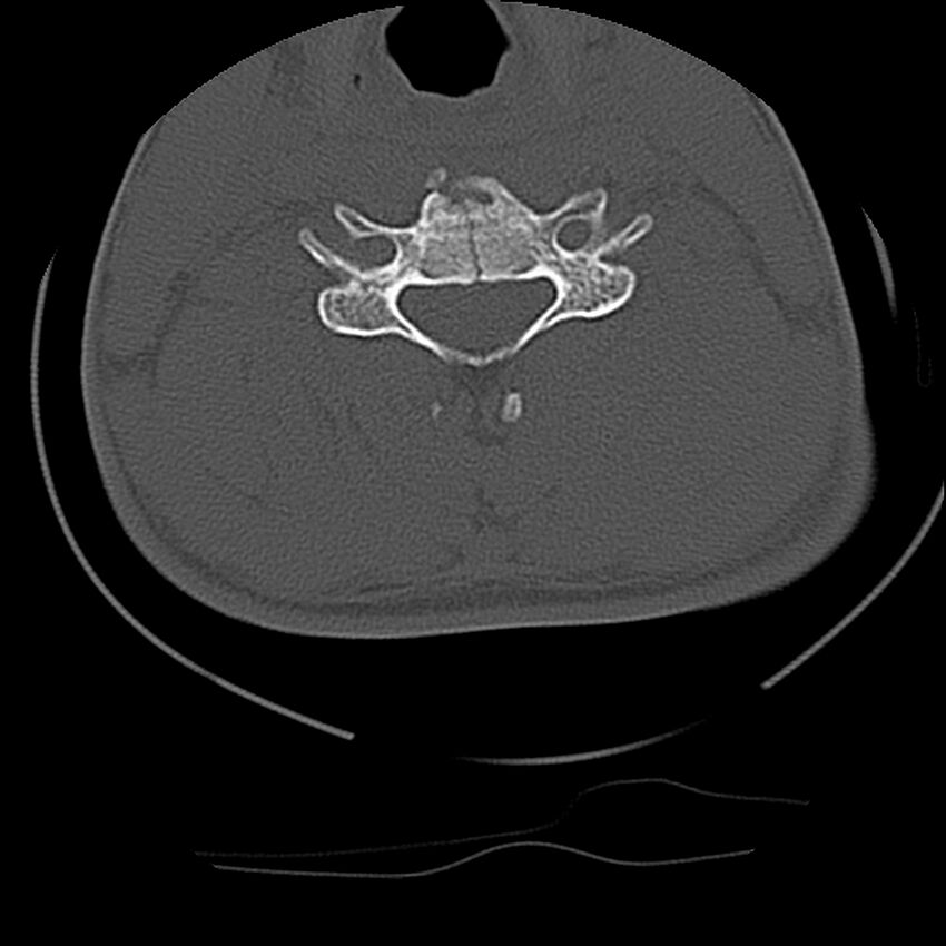 Cervical flexion teardrop fracture with cord hemorrhage (Radiopaedia 32497-33454 Axial bone window 50).jpg