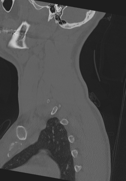 File:Cervical intercalary bone (Radiopaedia 35211-36748 Sagittal bone window 13).png