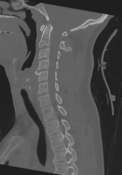 File:Cervical intercalary bone (Radiopaedia 35211-36748 Sagittal bone window 44).png