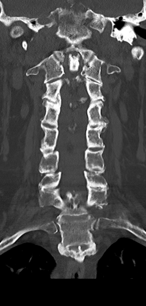 File:Cervical spine fracture - chalk stick (Radiopaedia 39116-41323 Coronal bone window 24).png