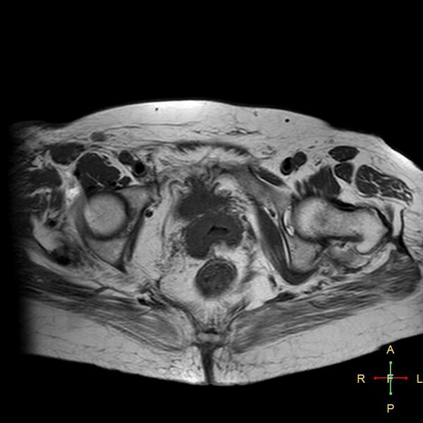 File:Cervical stump squamous cell carcinoma (Radiopaedia 48049-52858 Axial T1 6).jpg