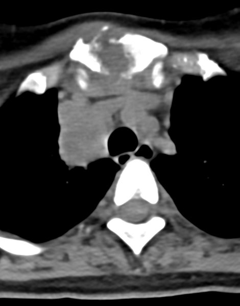 File:Cervical tuberculous spondylitis (Radiopaedia 39149-41365 Axial non-contrast 57).png