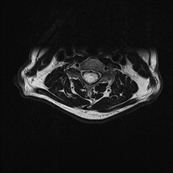 File:Cervical tumor-like myelopathy due to Type V dAVF (Radiopaedia 82461-96604 Axial T2 17).jpg