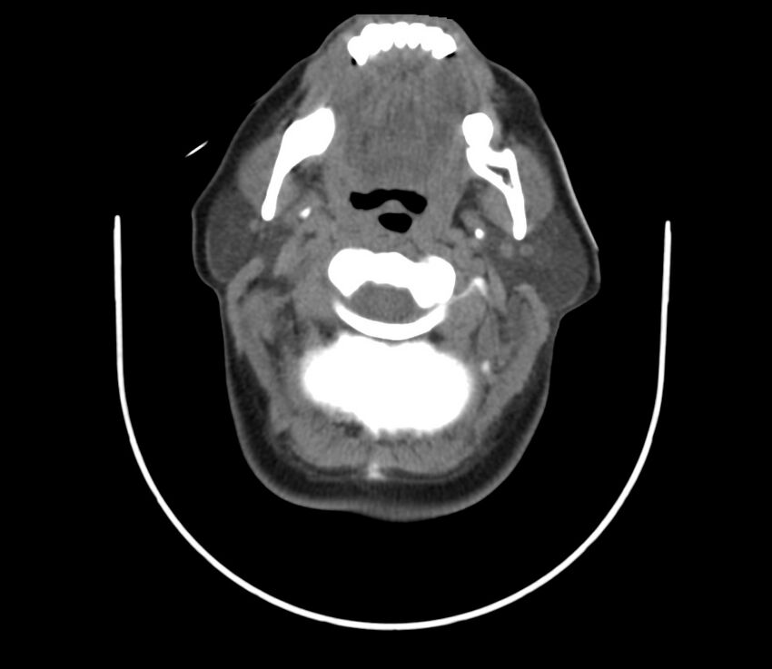 Cervical venous malformation (Radiopaedia 22653-22672 Axial non-contrast 22).jpg