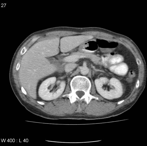 File:Chemotherapy induced enteritis (Radiopaedia 18594-18492 B 20).jpg