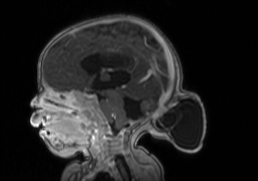 Chiari III malformation with occipital encephalocele (Radiopaedia 79446-92559 Sagittal T1 C+ mpr 38).jpg