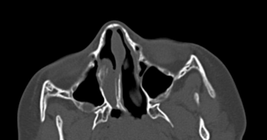 Choanal atresia (Radiopaedia 51295-56972 Axial bone window 25).jpg