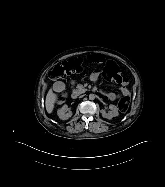 File:Cholangiocarcinoma with cerebral metastases (Radiopaedia 83519-98629 Axial non-contrast 41).jpg