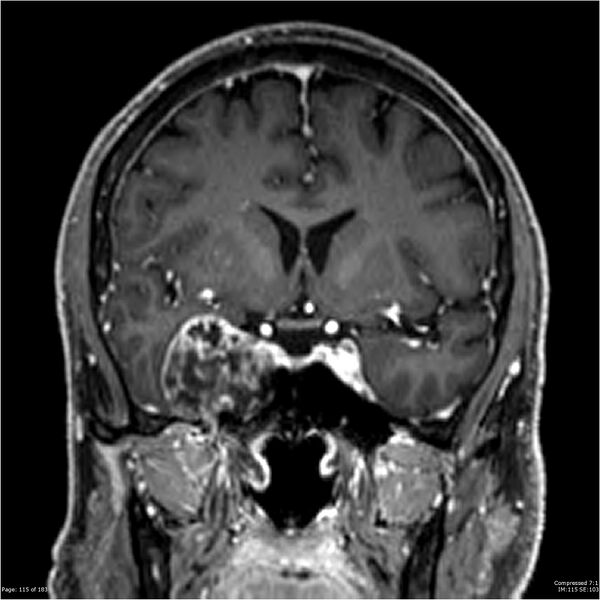 File:Chondrosarcoma of skull base- grade II (Radiopaedia 40948-43654 Coronal T1 C+ 26).jpg