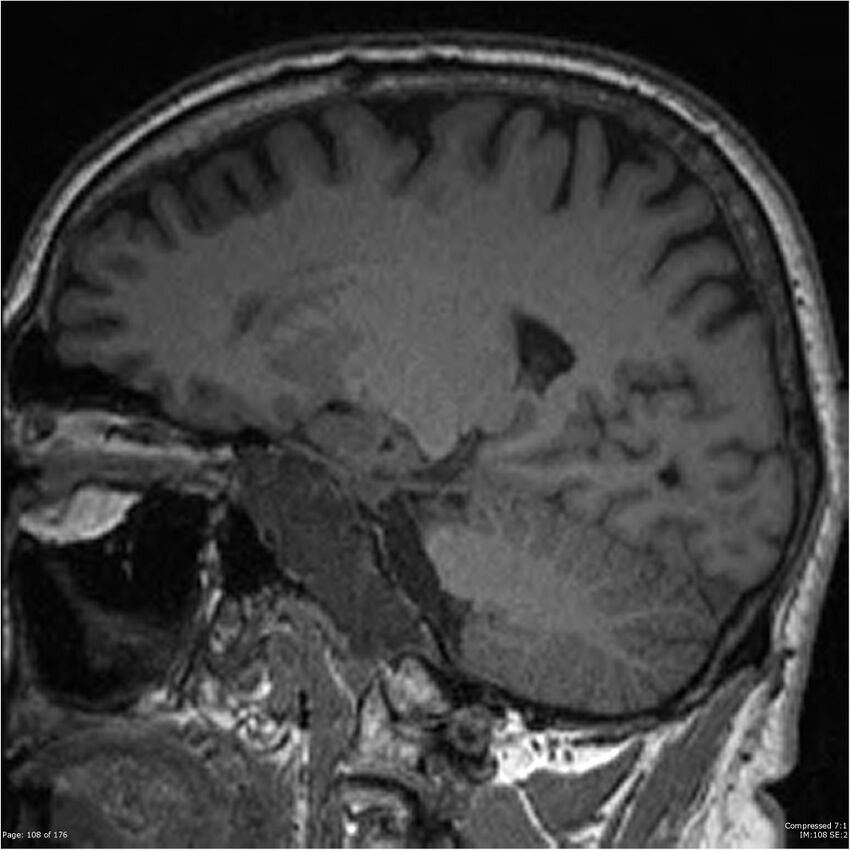 Chondrosarcoma of skull base- grade II (Radiopaedia 40948-43654 Sagittal T1 31).jpg