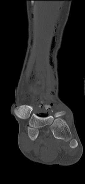 File:Chopart fracture (Radiopaedia 35347-36851 Coronal bone window 43).jpg