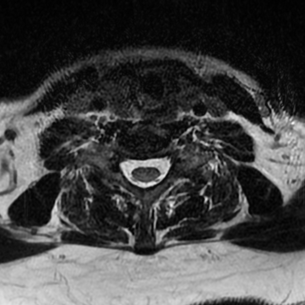 File:Chordoma - cervical spine (Radiopaedia 70084-80111 Axial T2 69).png