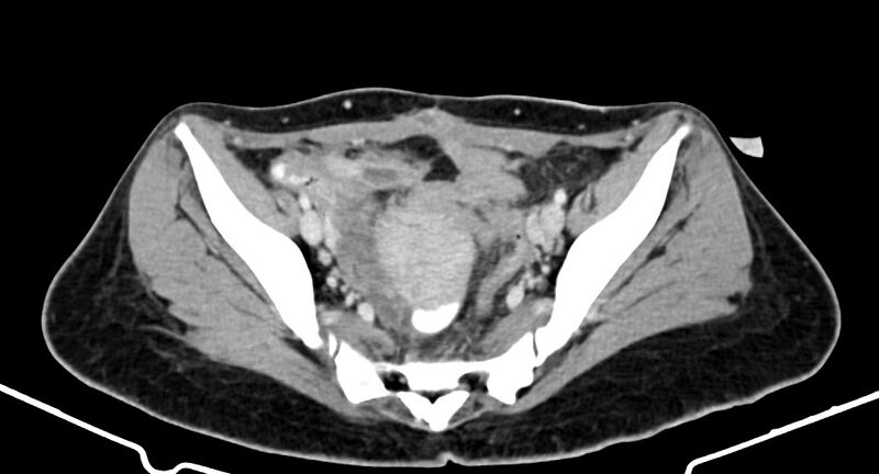 File:Choriocarcinoma liver metastases (Radiopaedia 74768-85766 A 171).jpg