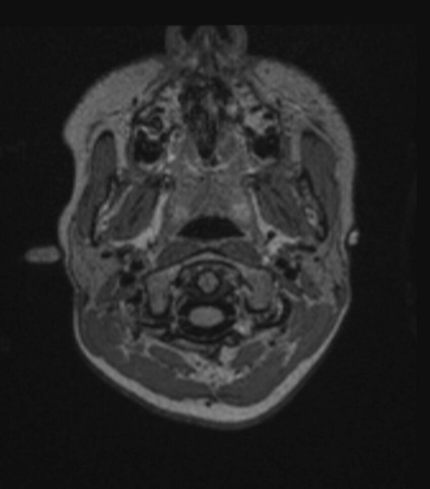 Choroid plexus carcinoma (Radiopaedia 91013-108553 Axial FLAIR C+ 60).jpg