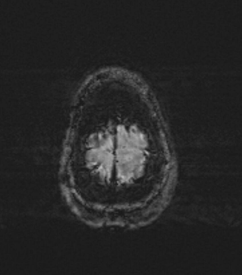 Choroid plexus carcinoma (Radiopaedia 91013-108553 Axial SWI 91).jpg