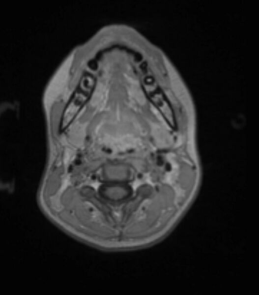 File:Choroid plexus carcinoma (Radiopaedia 91013-108553 Axial T1 C+ 32).jpg