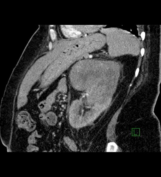 File:Chromophobe renal cell carcinoma (Radiopaedia 84239-99519 D 40).jpg
