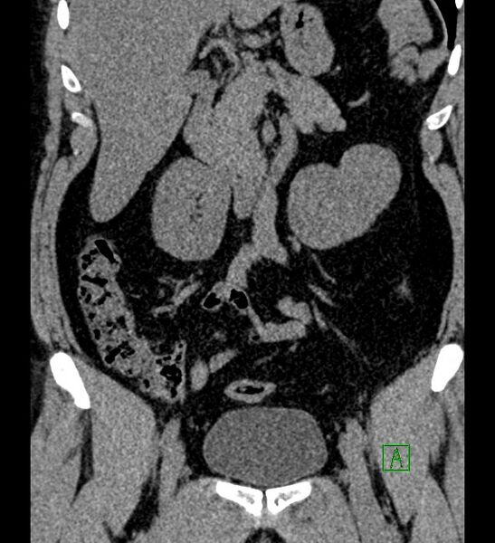 File:Chromophobe renal cell carcinoma (Radiopaedia 84286-99573 Coronal non-contrast 77).jpg